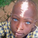This Little Boy Was Abandoned By His Mother Because Of His Unique Birth Mark [Photos] 2