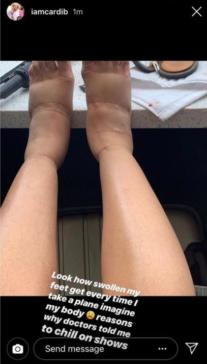 Cardi B Regrets Plastic Surgery, Shares Shocking Photos Of Swollen Feet As Side Effect 2 Cardi B Regrets Plastic Surgery, Shares Shocking Photos Of Swollen Feet As Side Effect 2