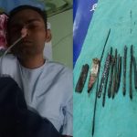 Doctors Remove 33 Sharp Objects Including Razors And Knives From Stomach Of A 30-Year-Old Man 2