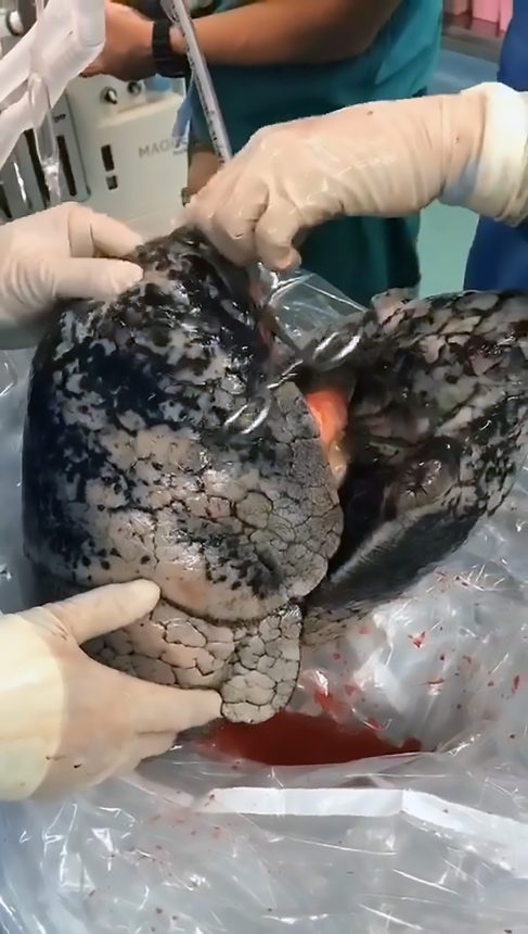Shocking Pictures Shows Black Lungs Of Man Who Smoked 20 Sticks Of Cigarettes Daily For Over 30 Year 2 Shocking Pictures Shows Black Lungs Of Man Who Smoked 20 Sticks Of Cigarettes Daily For Over 30 Year 2