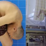 Medical Condition Makes Man Spend 28 Years Of His Life With His Head Stuck To His Knees 3
