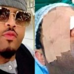 Actor, Mike Ezuruonye Undergoes Surgery Following Strange Growth On His Both Eyes 2
