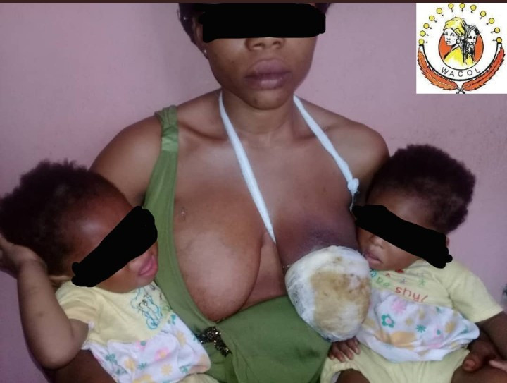 Nursing Mother Of Twins Left With Decayed Breast After Being Bitten By Her Uncle In Enugu