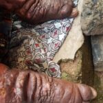 6 Things You Need To Know About Neglected Tropical Diseases In Nigeria 5