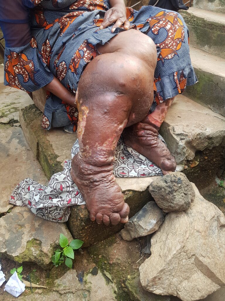 6 Things You Need To Know About Neglected Tropical Diseases In Nigeria 3 6 Things You Need To Know About Neglected Tropical Diseases In Nigeria 3