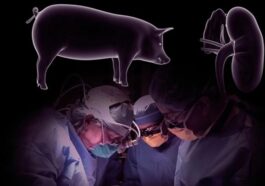 Surgeons Successfully Transplant Pig Kidney Into A Human Patient And It Worked