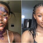 Burn Survivor Shows Off Her Amazing Transformation As Skin Heals Without Blemish
