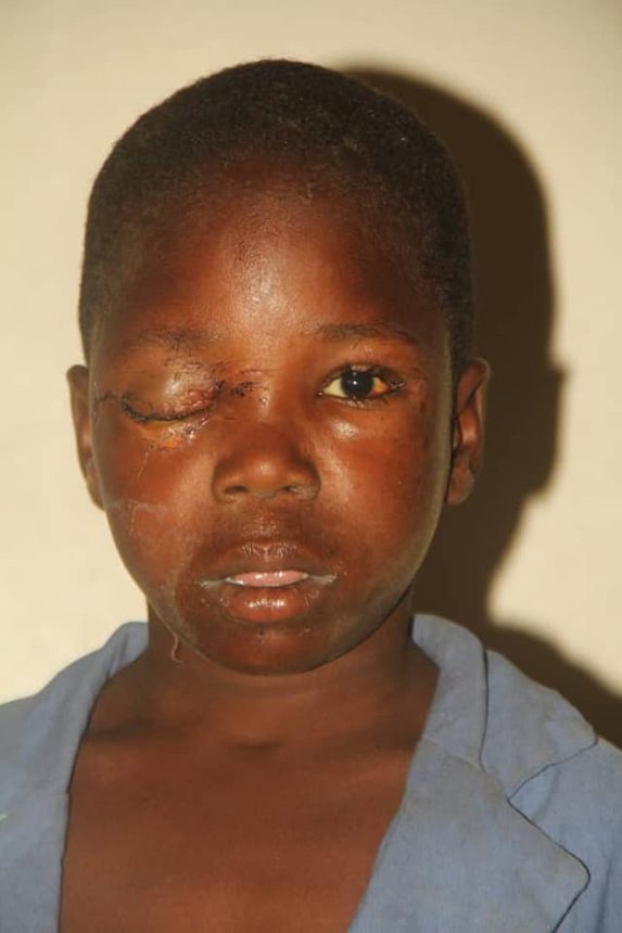 Suspected Ritualists Removes 12YearOld Boy's Eye In Bauchi Kanyi